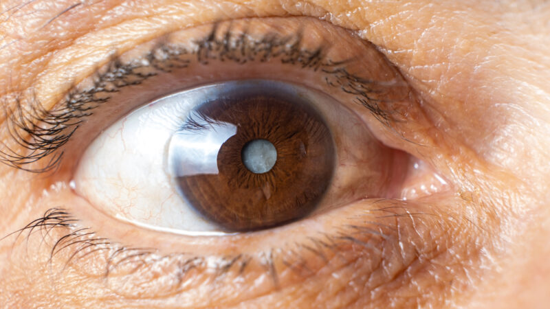 a cirurgia de catarata