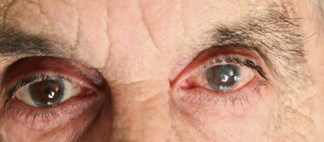 a cirurgia de catarata