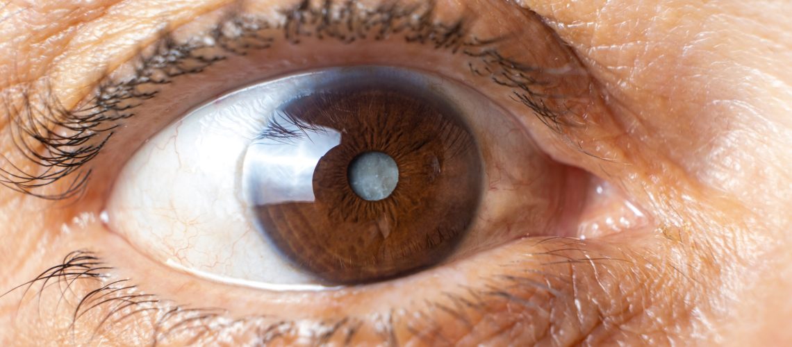 a cirurgia de catarata