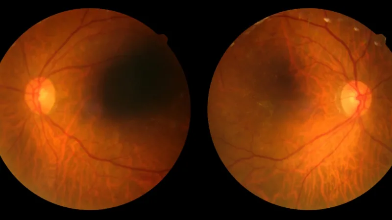 Retinopatia diabética