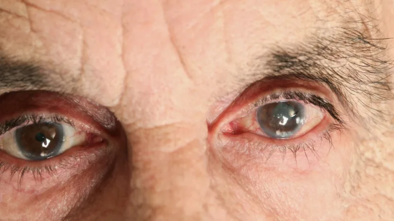a cirurgia de catarata