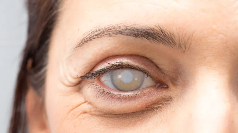 glaucoma