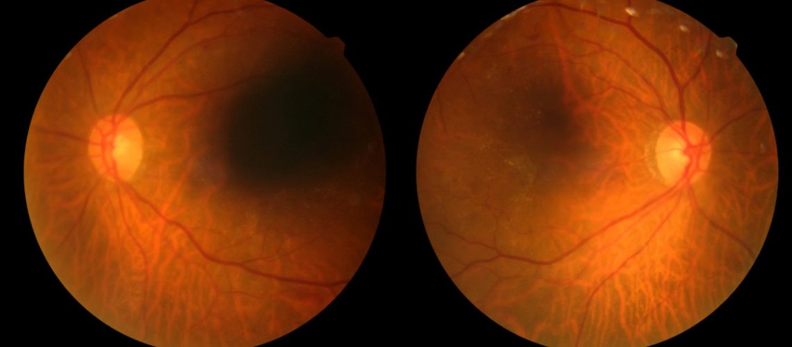 Retinopatia diabética